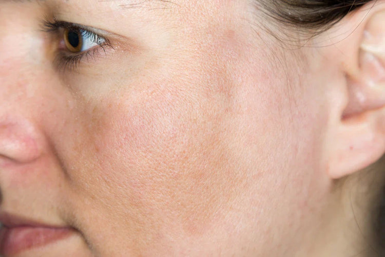 Húðvandamál - Litabreytingar/Dökkir blettir (Pigmentation)