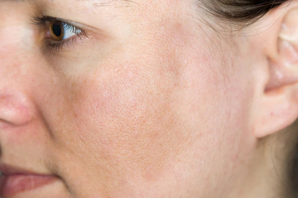 Húðvandamál - Litabreytingar/Dökkir blettir (Pigmentation)